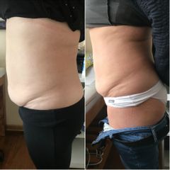 Lipo sin cirugía 