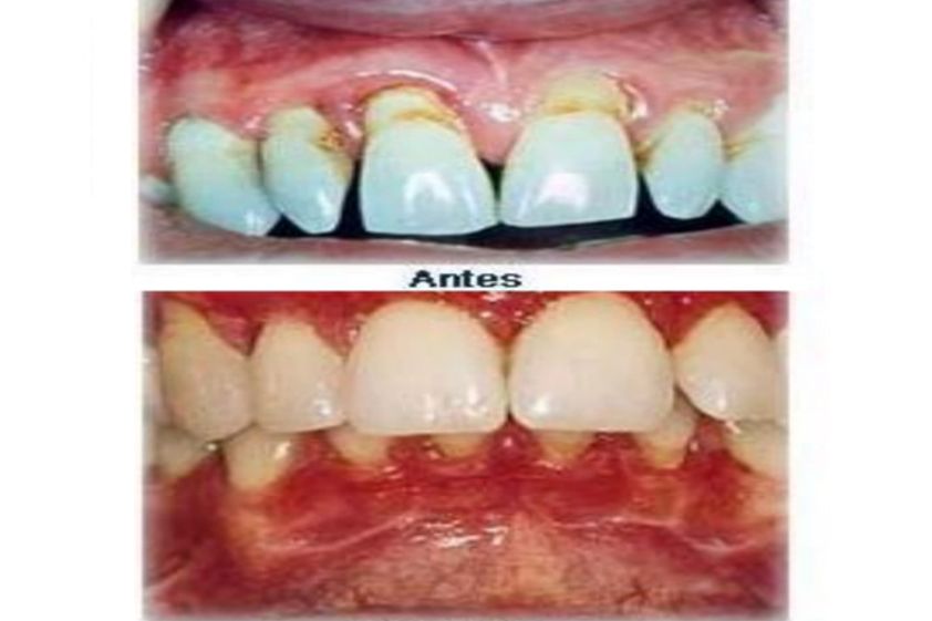 Periodoncia antes y después - 500849