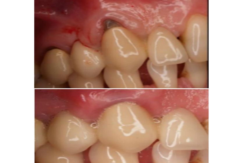 Endodoncia antes y después - 500869