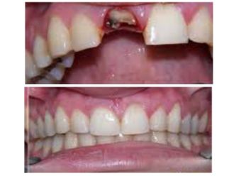 Extracción de dientes-500871