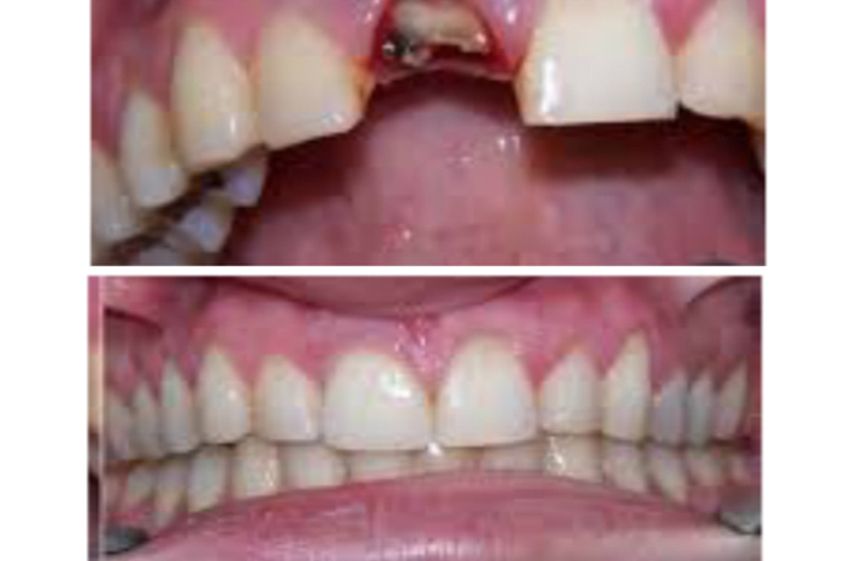 Extracción de dientes antes y después - 500871