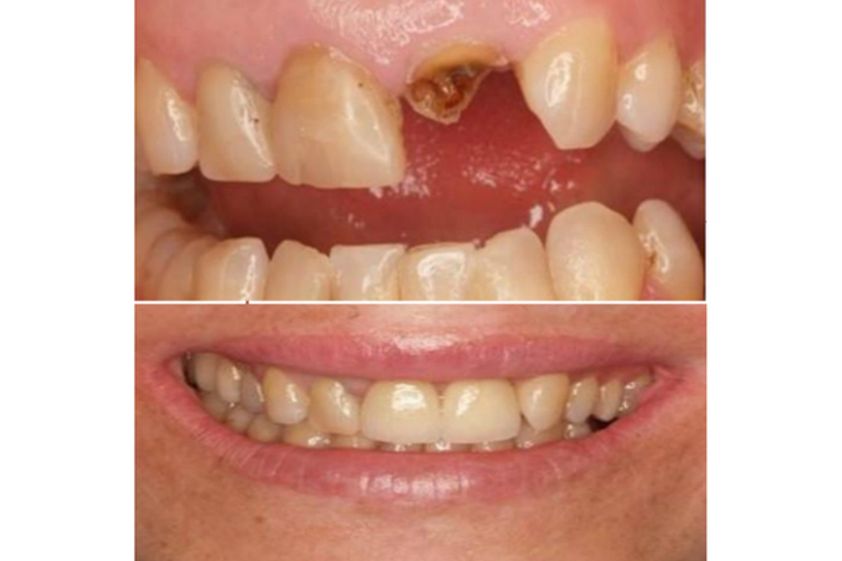 Extracción de dientes antes y después - 500872