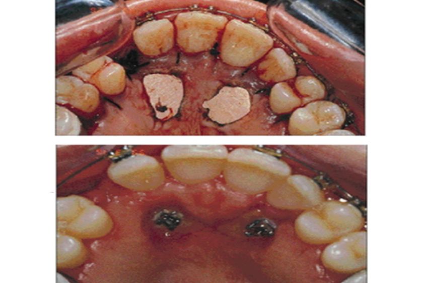 Endodoncia antes y después - 500873