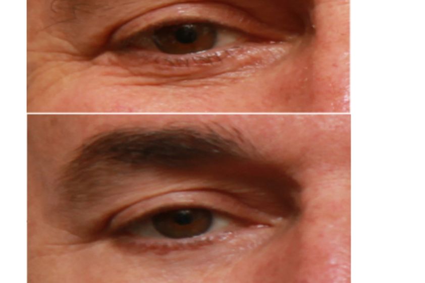 Tratamiento de bolsas en los ojos antes y después - 501503