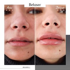 Aumento de labios - Belaser