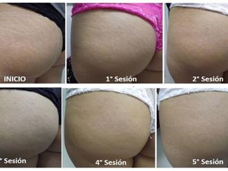 Tratamiento celulitis antes y después - 814014