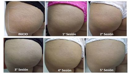 Tratamiento celulitis - Belaser