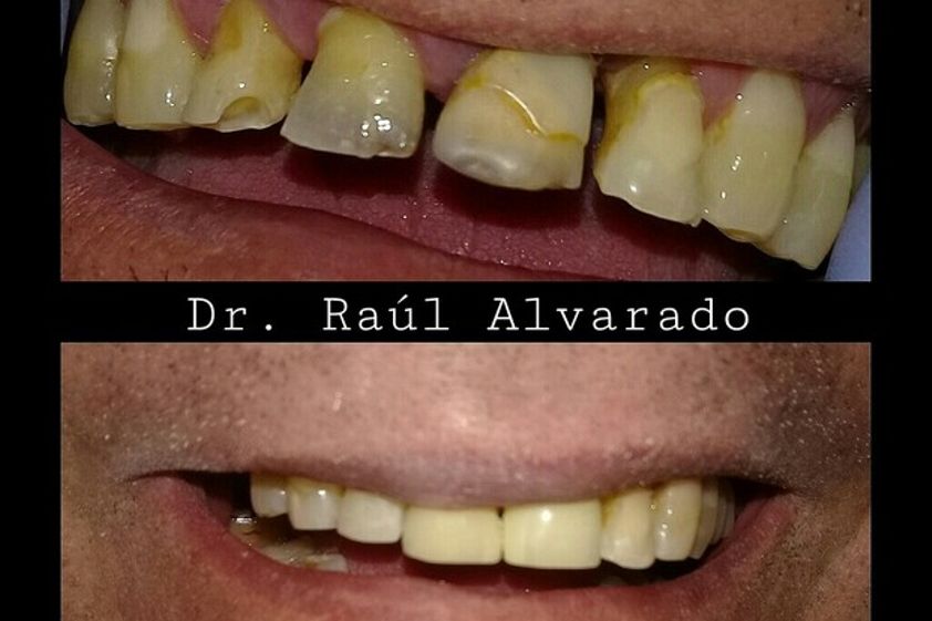 Prótesis dentales antes y después - 624390