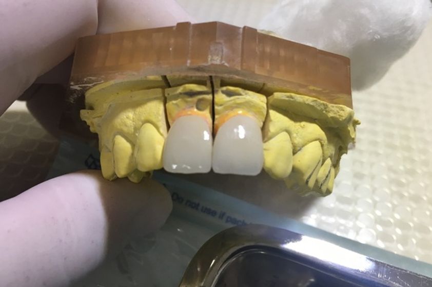 Prótesis dentales antes y después - 624391