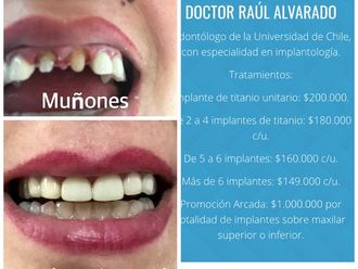 Carillas de porcelana - 624395