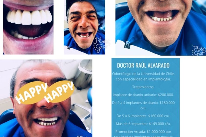 Implantes dentales antes y después - 624400