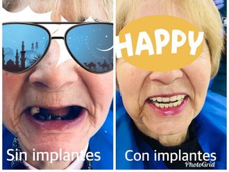 Implantes dentales - 624475