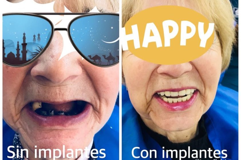 Implantes dentales antes y después - 624475