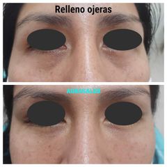 Relleno ojeras - AURASALUD