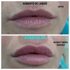 Aumento y perfilado de labios - AURASALUD