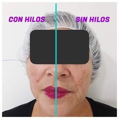 Hilos tensores faciales - AURASALUD