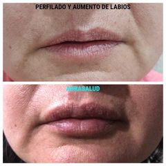 Perfilado y aumento de labios - AURASALUD