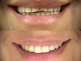 Carillas dentales - 854679