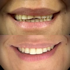 Carillas dentales - Dra. Andrea Paz Molina Urrutia