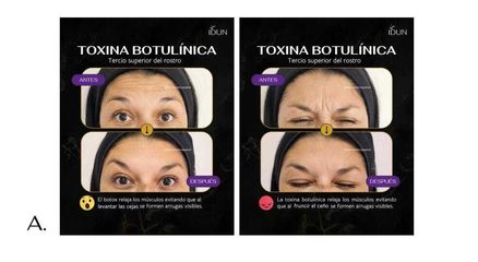 Bótox - IDUN