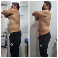 Tratamiento reductivo crio avanzada - Centro Kinésico Balance