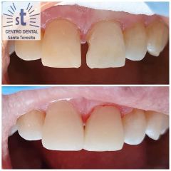 Implantes dentales - Centro Dental Santa Teresita Quilpue