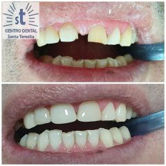 Implantes dentales - Centro Dental Santa Teresita Quilpue
