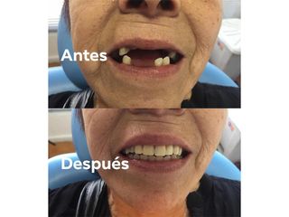 Prótesis dentales - Centro Dental Santa Teresita Quilpue