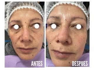 Relleno de ojeras y surcos nasogeniano