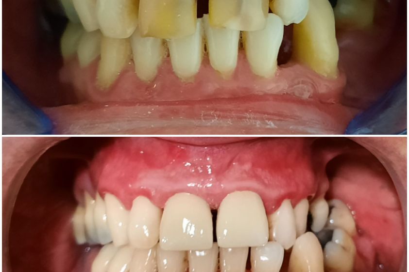 Carillas dentales antes y después - 742146
