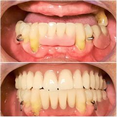 Prótesis dentales - Dra. Rocío Rocha