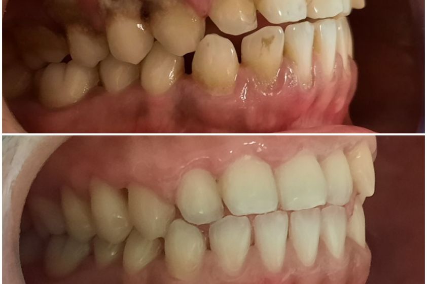 Limpieza dental antes y después - 794999