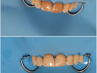 Blanquear dientes-795594