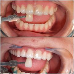 Blanqueamiento dental - Dra. Rocío Rocha