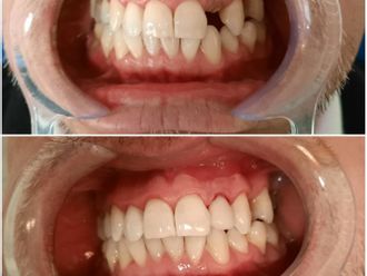 Prótesis dentales - 800209