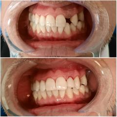 Prótesis dental - Dra. Rocío Rocha