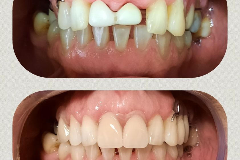 Carillas dentales antes y después - 811635
