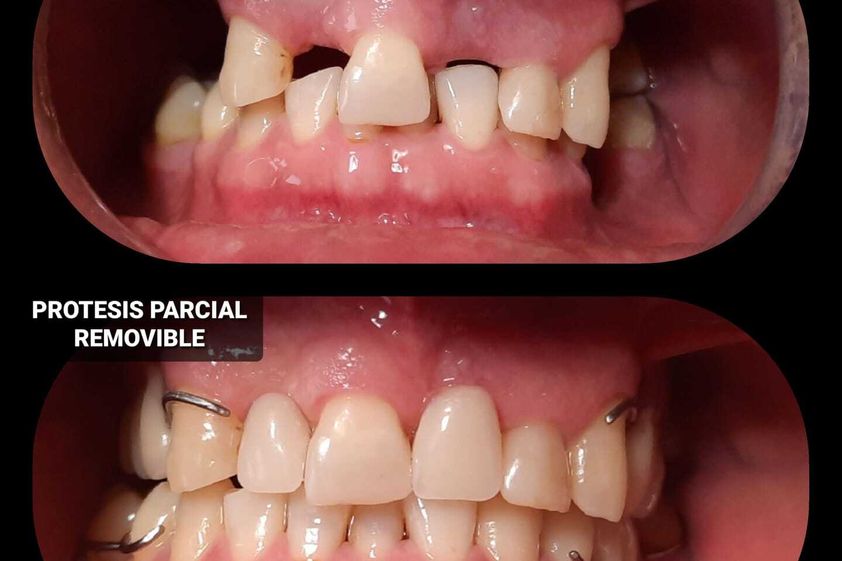 Prótesis dentales antes y después - 814284