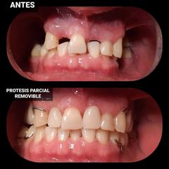 Prótesis dentales - Dra. Rocío Rocha