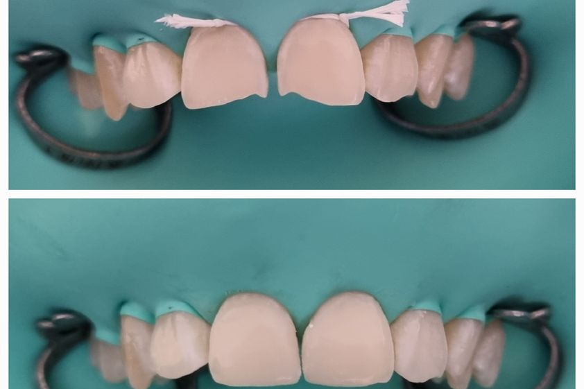 Carillas dentales antes y después - 823274