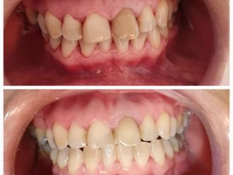 Blanquear dientes - 853412