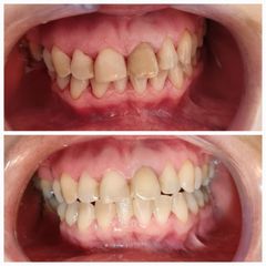 Blanqueamiento interno de diente con endodoncia - Dra. Rocío Rocha