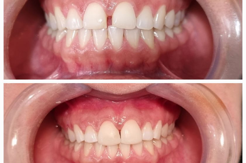 Endodoncia antes y después - 853413