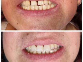 Carillas dentales - 853414