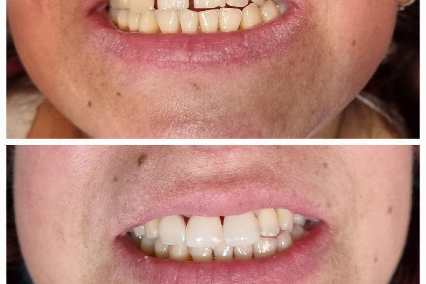 Carillas dentales antes y después - 853414