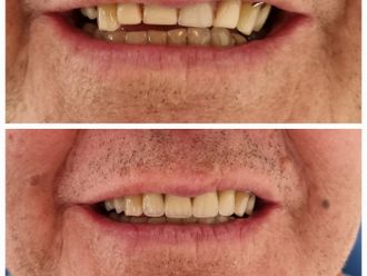 Carillas dentales - 853415