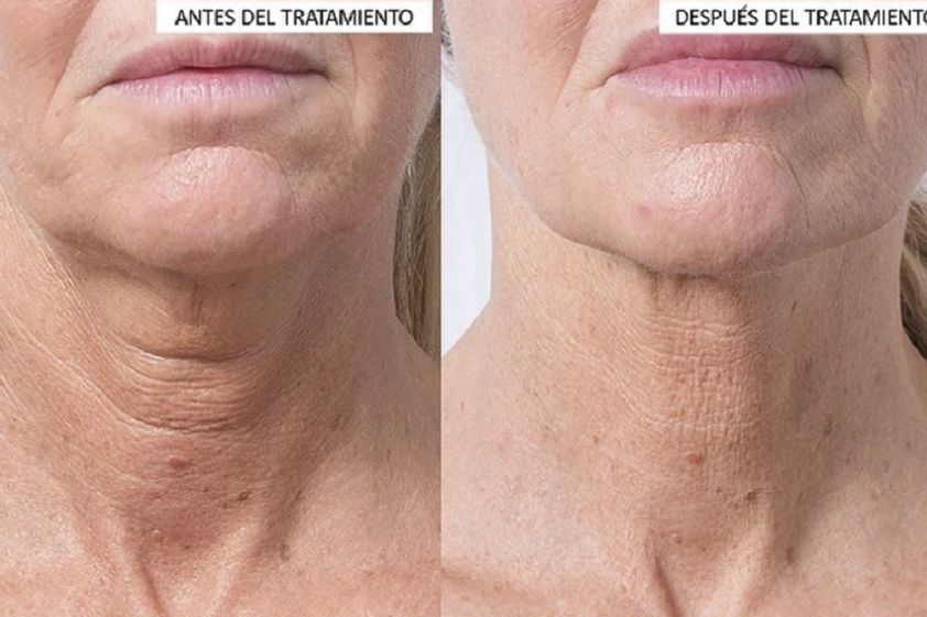 Lipoláser antes y después - 791192