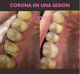 Coronas dentales - Clínica Belive