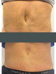 Profhilo post abdominoplastía - Dr. Mauricio Aspée Roa