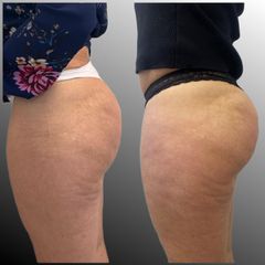Acido Poliláctico para glúteos - Dr. Mauricio Aspée Roa